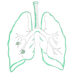 Emphysema (COPD)